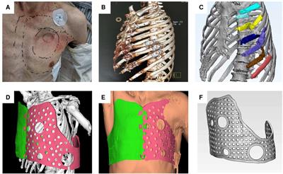3D-printed external fixation guide combined with video-assisted thoracoscopic surgery for the treatment of flail chest: a technical report and case series
